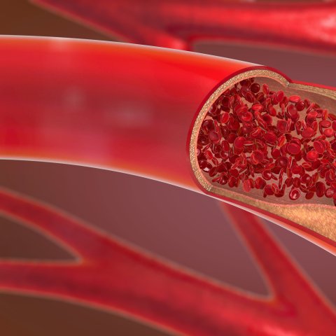 Bei einer Atherosklerose kommt es zu Ablagerungen in den Blutgefäßen, die den Blutfluss behindern können.